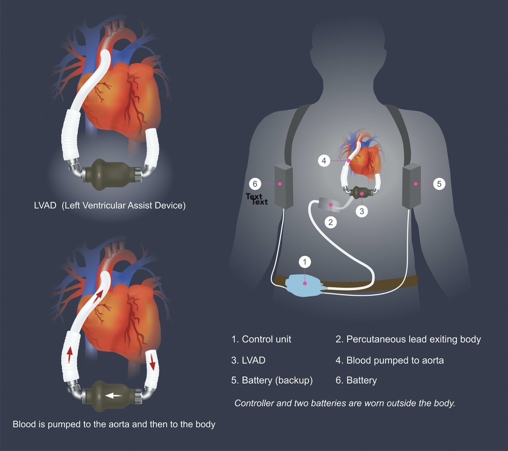 LVAD: Review of historical context, clinical indications, and device-related adverse events 
